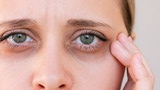 How To Reduce The Appearance Of Dark Circles Under The Eyes