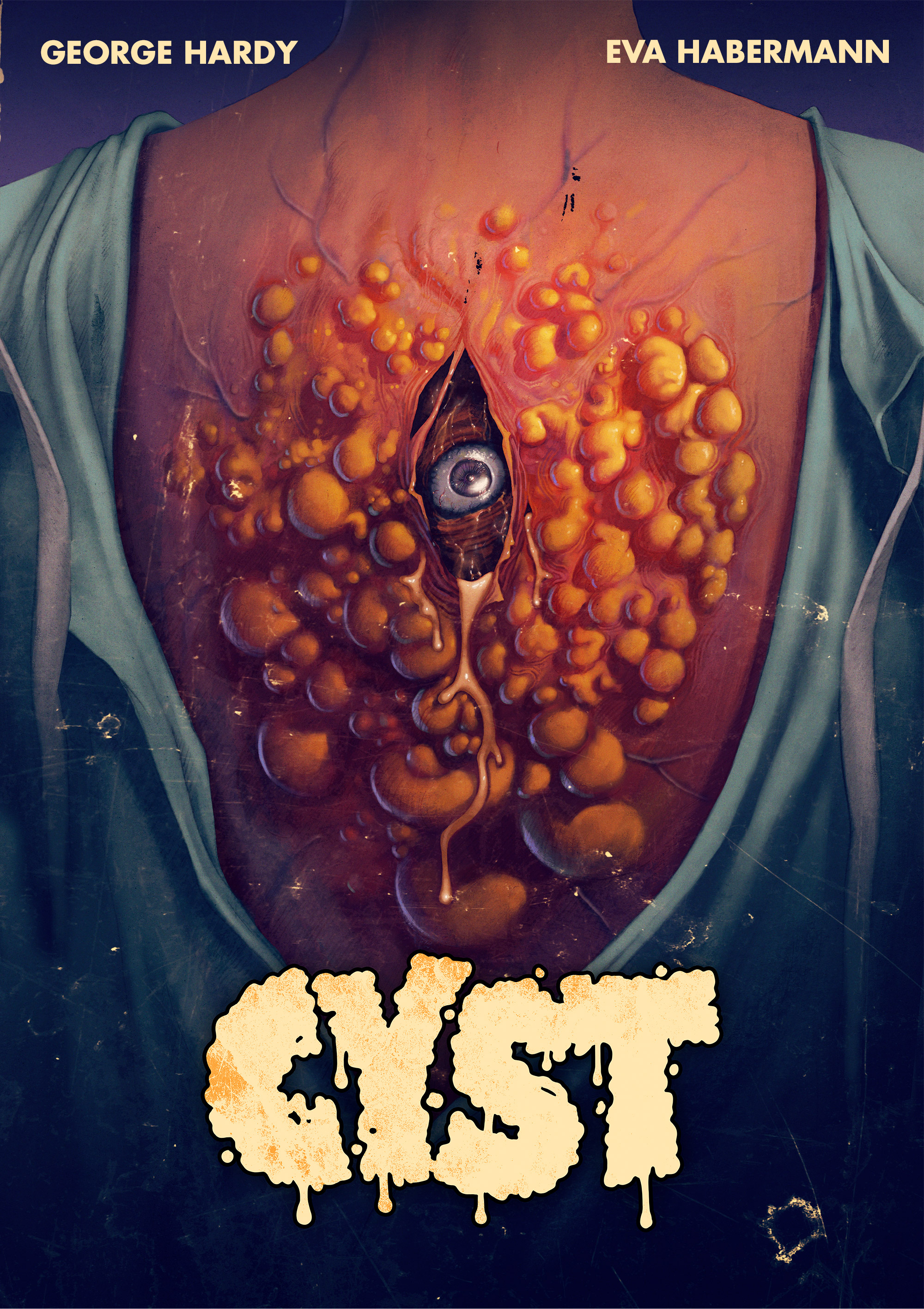 Cyst