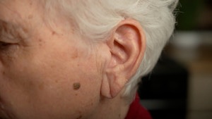 Un Pli Dans L'Oreille Peut Être Un Signe Avant-Coureur D'Une Crise Cardiaque