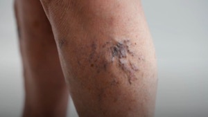 Les Maladies Veineuses Les Plus Fréquentes Avec Le Vieillissement